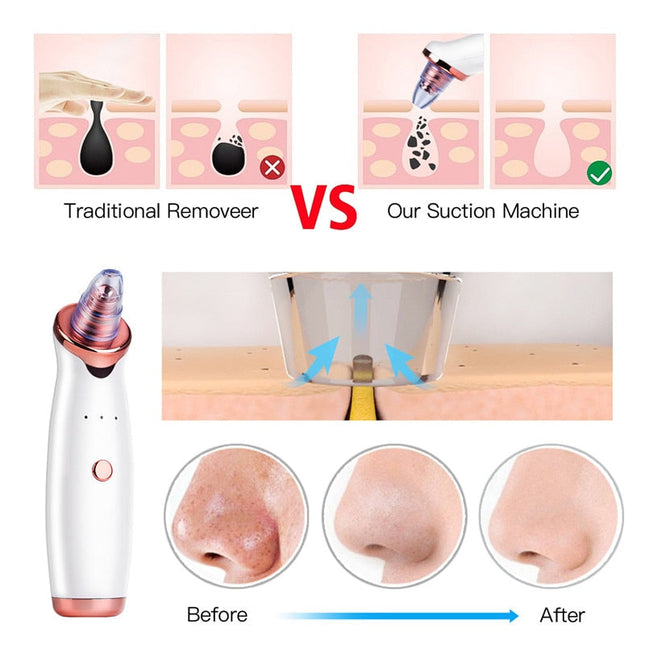 Blackhead Remover